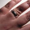 В Казани восстановили палец после отрыва тканей обручальным кольцом
